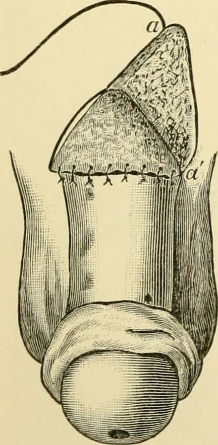 An illustration from Surgical technic; a text-book on operative surgery / by Fr. von Esmarch ... and E. Kowalzig ... translated by Professor Ludwig H. Grau ... and Willam N. Sullivan ... edited by Nicholas Senn ... With fourteen hundred and ninety-seven illustrations and fifteen colored plates., 1901, leaf 866