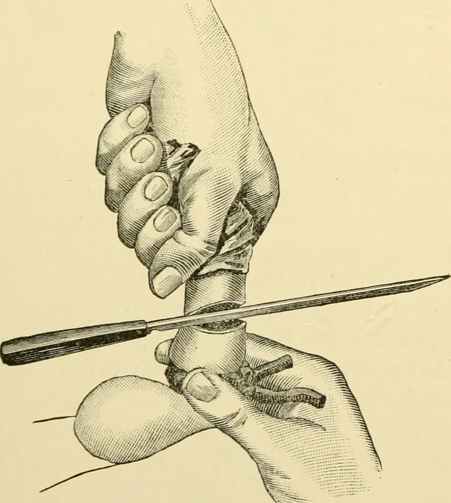 An illustration from Surgical technic; a text-book on operative surgery / by Fr. von Esmarch ... and E. Kowalzig ... translated by Professor Ludwig H. Grau ... and Willam N. Sullivan ... edited by Nicholas Senn ... With fourteen hundred and ninety-seven illustrations and fifteen colored plates., 1901, leaf 872