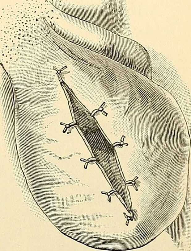 An illustration from Surgical technic; a text-book on operative surgery / by Fr. von Esmarch ... and E. Kowalzig ... translated by Professor Ludwig H. Grau ... and Willam N. Sullivan ... edited by Nicholas Senn ... With fourteen hundred and ninety-seven illustrations and fifteen colored plates., 1901, leaf 875