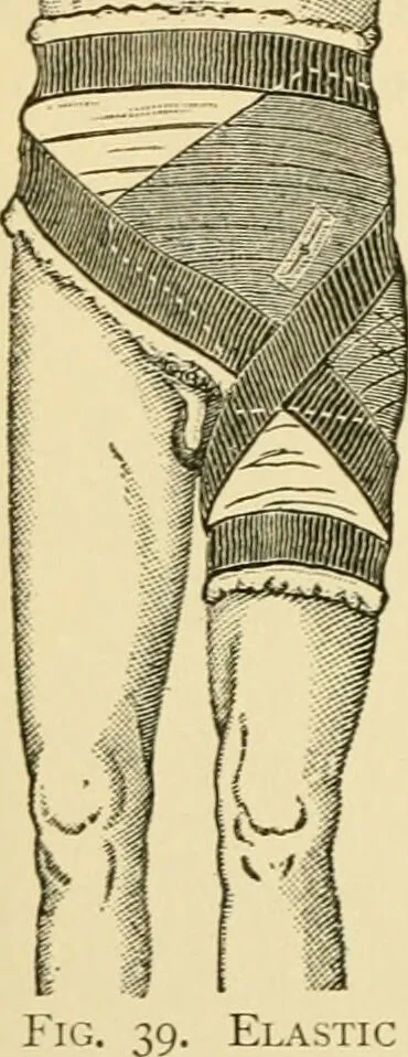 An illustration from Surgical technic; a text-book on operative surgery / by Fr. von Esmarch ... and E. Kowalzig ... translated by Professor Ludwig H. Grau ... and Willam N. Sullivan ... edited by Nicholas Senn ... With fourteen hundred and ninety-seven illustrations and fifteen colored plates., 1901, leaf 88