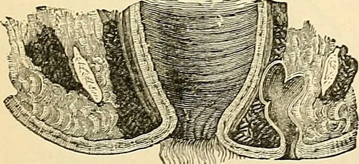 An illustration from Surgical technic; a text-book on operative surgery / by Fr. von Esmarch ... and E. Kowalzig ... translated by Professor Ludwig H. Grau ... and Willam N. Sullivan ... edited by Nicholas Senn ... With fourteen hundred and ninety-seven illustrations and fifteen colored plates., 1901, leaf 885