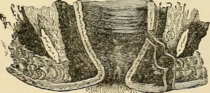 An illustration from Surgical technic; a text-book on operative surgery / by Fr. von Esmarch ... and E. Kowalzig ... translated by Professor Ludwig H. Grau ... and Willam N. Sullivan ... edited by Nicholas Senn ... With fourteen hundred and ninety-seven illustrations and fifteen colored plates., 1901, leaf 885