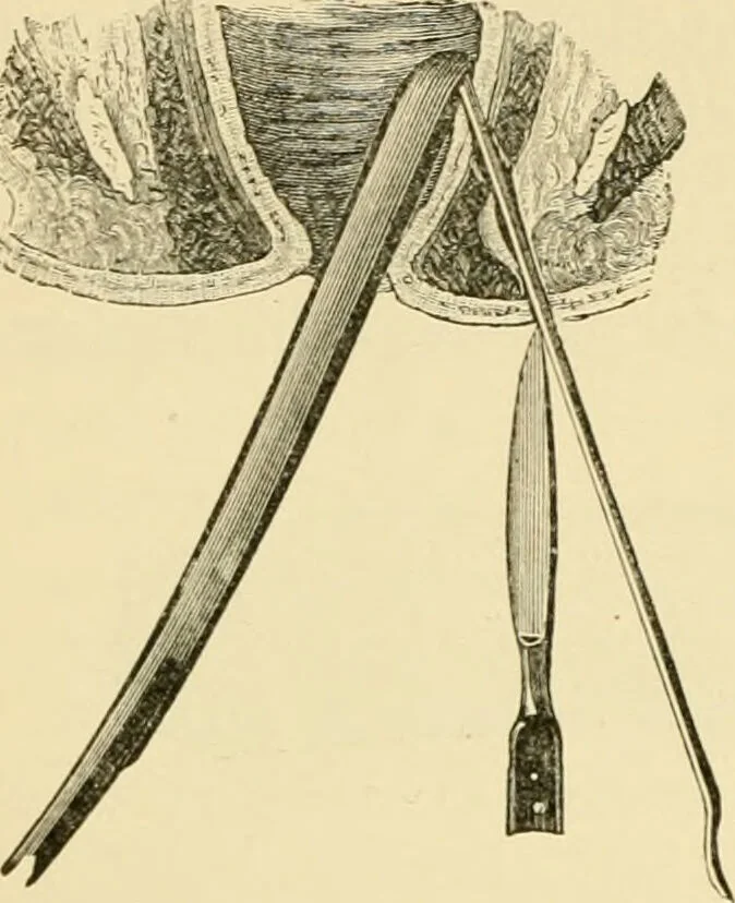 An illustration from Surgical technic; a text-book on operative surgery / by Fr. von Esmarch ... and E. Kowalzig ... translated by Professor Ludwig H. Grau ... and Willam N. Sullivan ... edited by Nicholas Senn ... With fourteen hundred and ninety-seven illustrations and fifteen colored plates., 1901, leaf 888