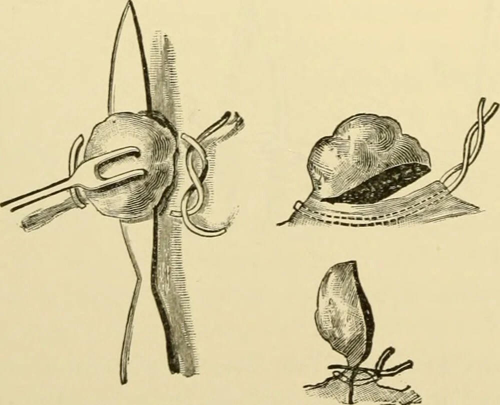 An illustration from Surgical technic; a text-book on operative surgery / by Fr. von Esmarch ... and E. Kowalzig ... translated by Professor Ludwig H. Grau ... and Willam N. Sullivan ... edited by Nicholas Senn ... With fourteen hundred and ninety-seven illustrations and fifteen colored plates., 1901, leaf 892