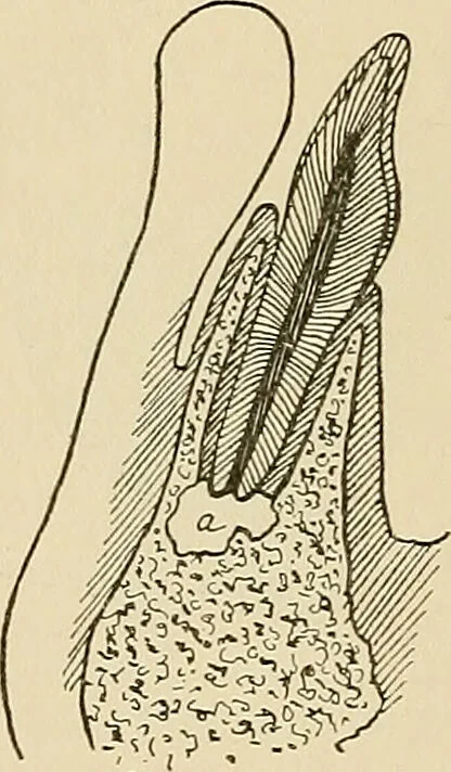An illustration from The practice of dental medicine / By George F. Eames. Containing thirty-eight engravings and three colored plates., 1899, leaf 202