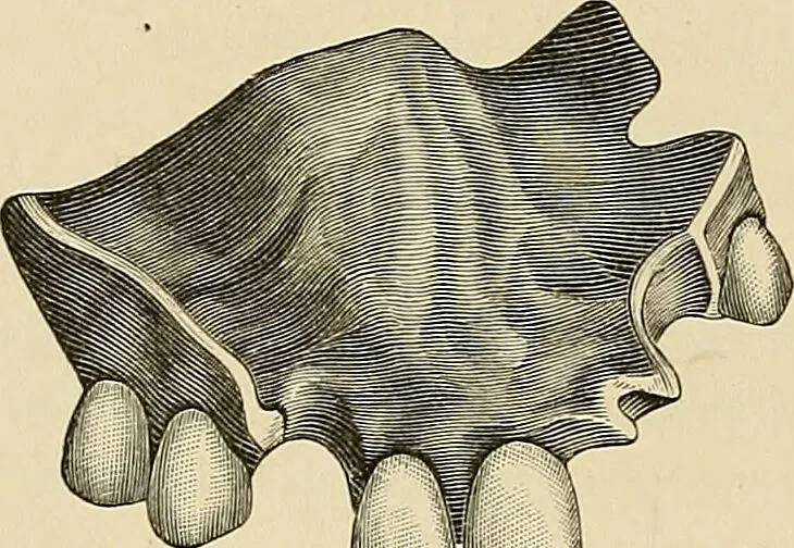 An illustration from The practice of dental medicine / By George F. Eames. Containing thirty-eight engravings and three colored plates., 1899, leaf 80