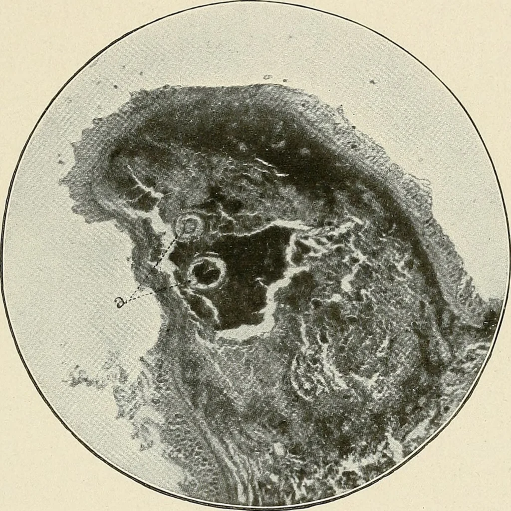 An illustration from Hookworm disease : etiology, pathology, diagnosis, prognosis, prophylaxis, and treatment / by George Dock and Charles C. Bass. Illustrated with forty-nine special engravings and colored plate., 1910, leaf 105