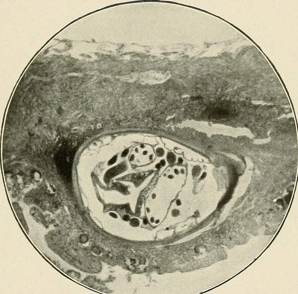 An illustration from Hookworm disease : etiology, pathology, diagnosis, prognosis, prophylaxis, and treatment / by George Dock and Charles C. Bass. Illustrated with forty-nine special engravings and colored plate., 1910, leaf 113