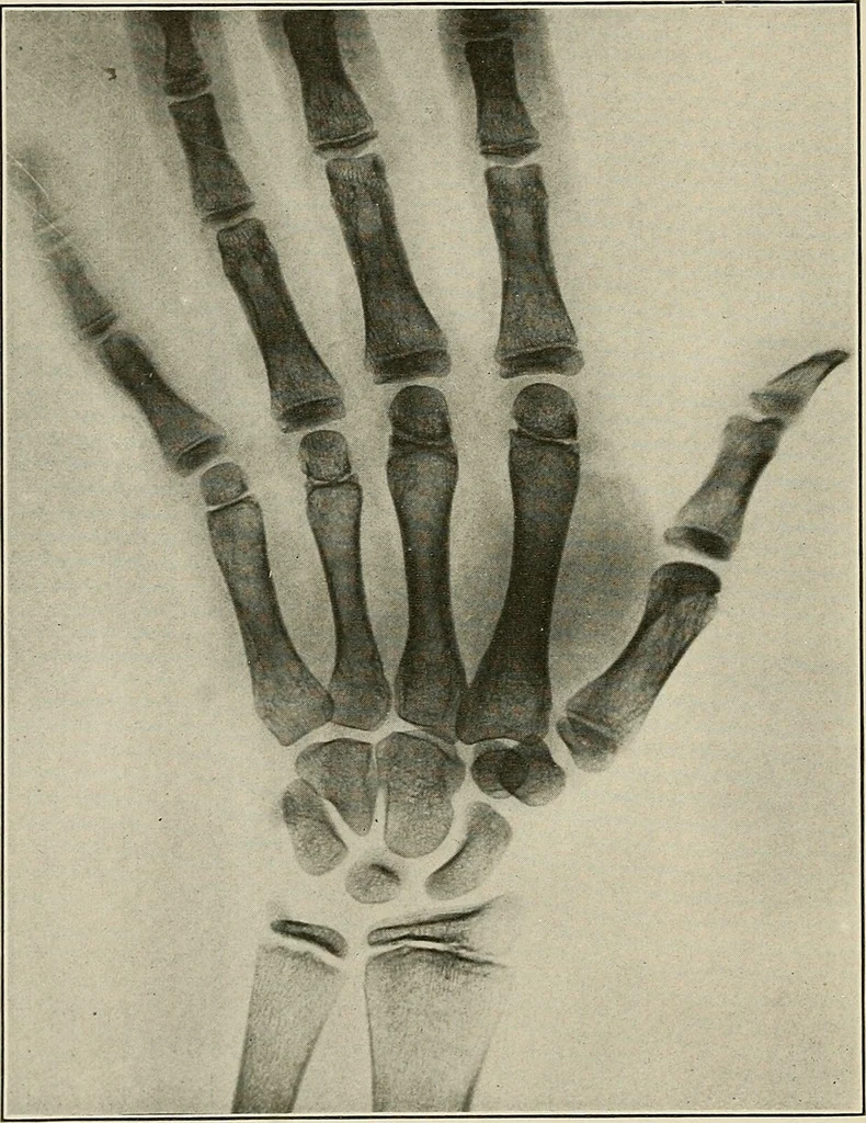 An illustration from Hookworm disease : etiology, pathology, diagnosis, prognosis, prophylaxis, and treatment / by George Dock and Charles C. Bass. Illustrated with forty-nine special engravings and colored plate., 1910, leaf 136