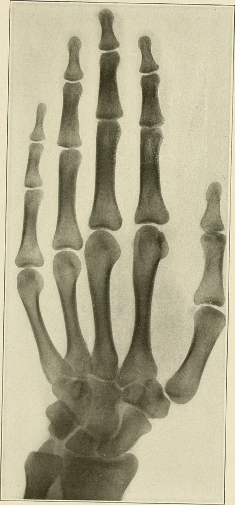 An illustration from Hookworm disease : etiology, pathology, diagnosis, prognosis, prophylaxis, and treatment / by George Dock and Charles C. Bass. Illustrated with forty-nine special engravings and colored plate., 1910, leaf 137