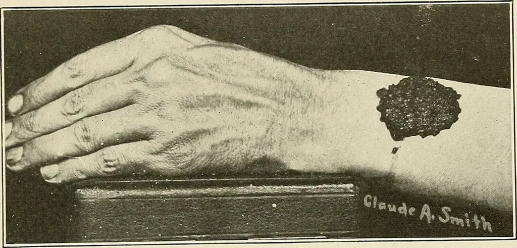 An illustration from Hookworm disease : etiology, pathology, diagnosis, prognosis, prophylaxis, and treatment / by George Dock and Charles C. Bass. Illustrated with forty-nine special engravings and colored plate., 1910, leaf 83