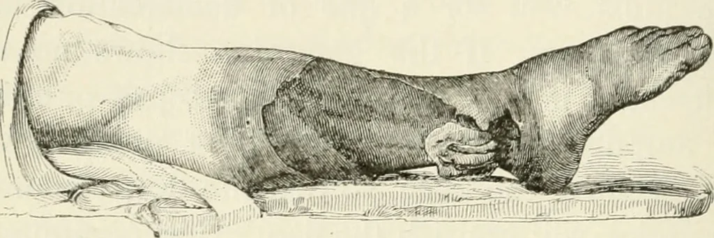 An illustration from A manual of modern surgery, general and operative : With 188 illus. in the text and 13 full-page plates in colors and tints, aggregating 276 separate figures., 1894, leaf 128