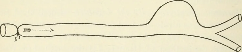 An illustration from A manual of modern surgery, general and operative : With 188 illus. in the text and 13 full-page plates in colors and tints, aggregating 276 separate figures., 1894, leaf 252