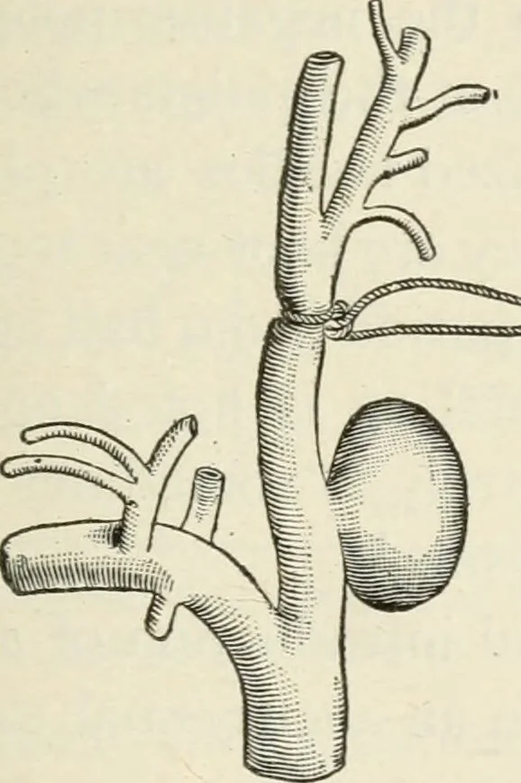 An illustration from A manual of modern surgery, general and operative : With 188 illus. in the text and 13 full-page plates in colors and tints, aggregating 276 separate figures., 1894, leaf 253