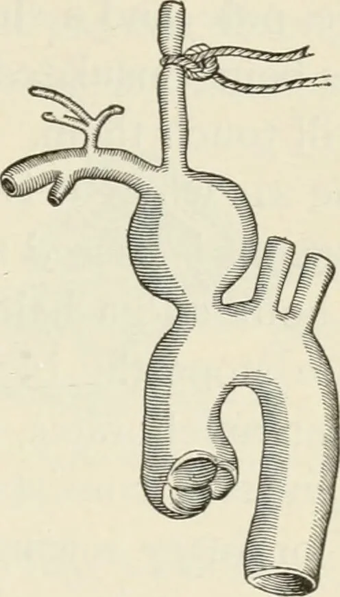 An illustration from A manual of modern surgery, general and operative : With 188 illus. in the text and 13 full-page plates in colors and tints, aggregating 276 separate figures., 1894, leaf 253