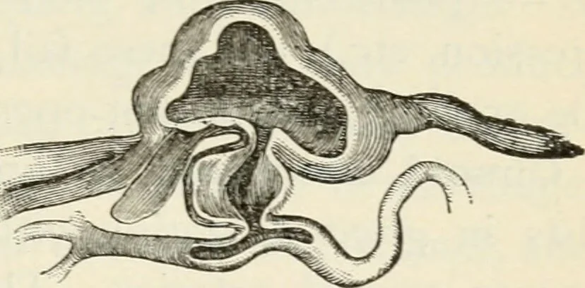 An illustration from A manual of modern surgery, general and operative : With 188 illus. in the text and 13 full-page plates in colors and tints, aggregating 276 separate figures., 1894, leaf 255