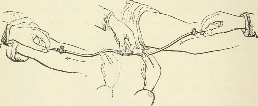 An illustration from A manual of modern surgery, general and operative : With 188 illus. in the text and 13 full-page plates in colors and tints, aggregating 276 separate figures., 1894, leaf 278