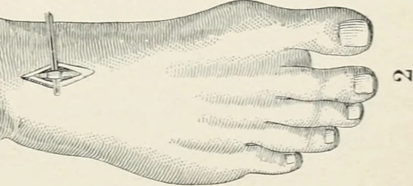 An illustration from A manual of modern surgery, general and operative : With 188 illus. in the text and 13 full-page plates in colors and tints, aggregating 276 separate figures., 1894, leaf 305