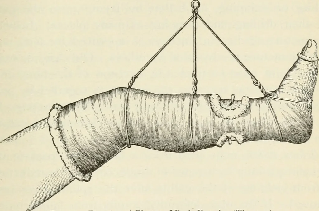 An illustration from A manual of modern surgery, general and operative : With 188 illus. in the text and 13 full-page plates in colors and tints, aggregating 276 separate figures., 1894, leaf 349
