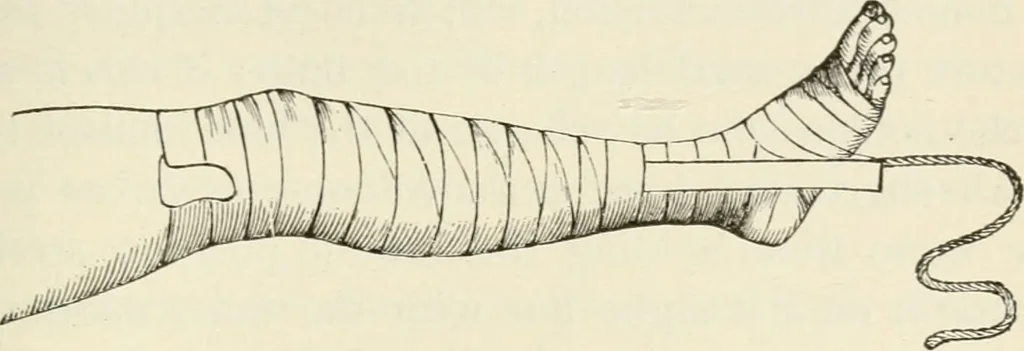An illustration from A manual of modern surgery, general and operative : With 188 illus. in the text and 13 full-page plates in colors and tints, aggregating 276 separate figures., 1894, leaf 403