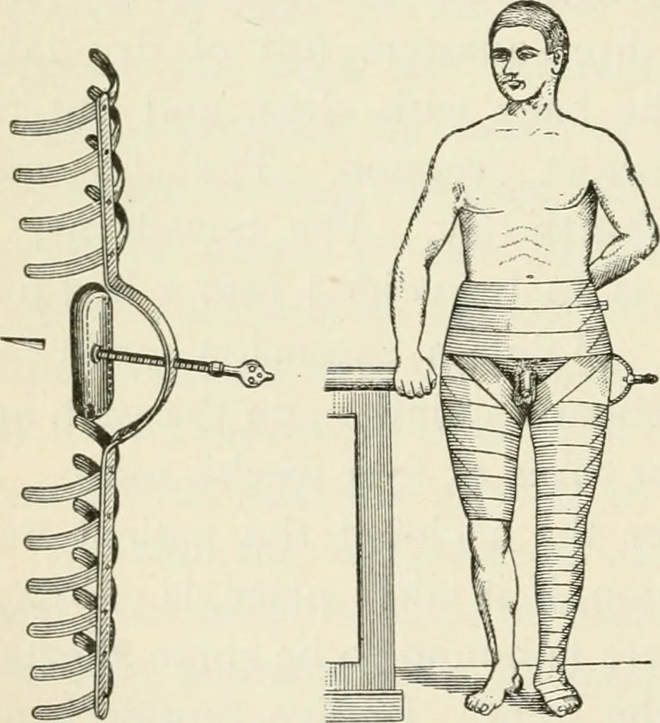 An illustration from A manual of modern surgery, general and operative : With 188 illus. in the text and 13 full-page plates in colors and tints, aggregating 276 separate figures., 1894, leaf 404