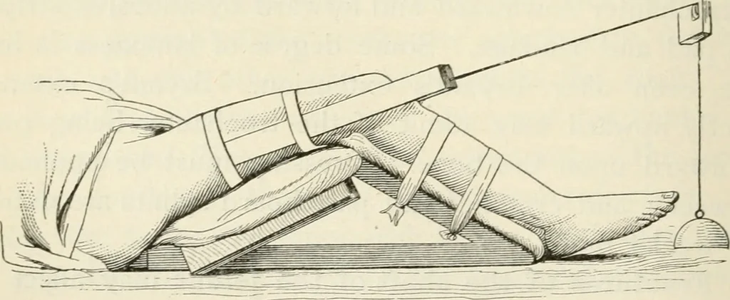An illustration from A manual of modern surgery, general and operative : With 188 illus. in the text and 13 full-page plates in colors and tints, aggregating 276 separate figures., 1894, leaf 408