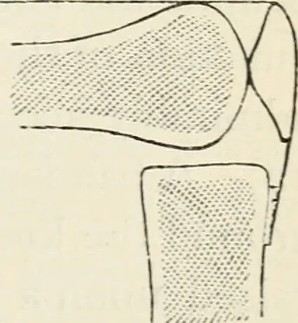 An illustration from A manual of modern surgery, general and operative : With 188 illus. in the text and 13 full-page plates in colors and tints, aggregating 276 separate figures., 1894, leaf 411