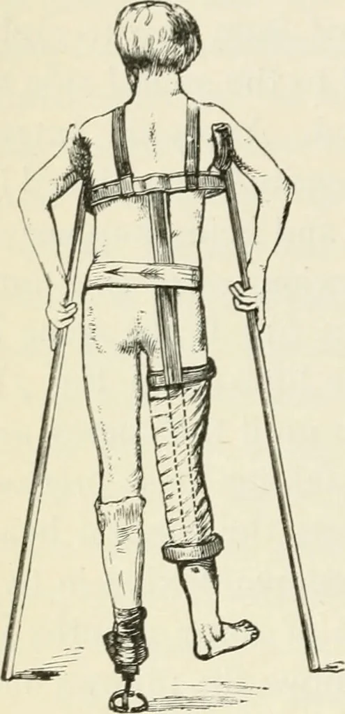 An illustration from A manual of modern surgery, general and operative : With 188 illus. in the text and 13 full-page plates in colors and tints, aggregating 276 separate figures., 1894, leaf 434