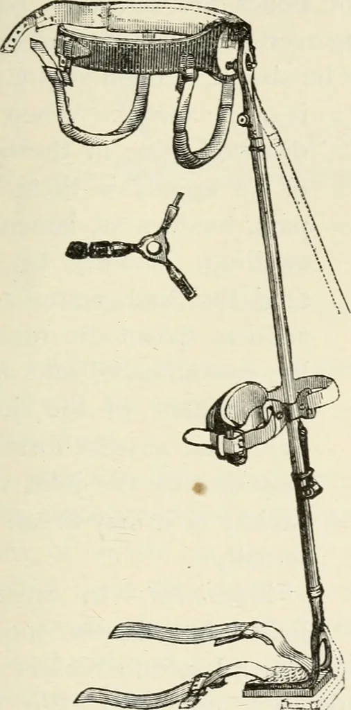 An illustration from A manual of modern surgery, general and operative : With 188 illus. in the text and 13 full-page plates in colors and tints, aggregating 276 separate figures., 1894, leaf 435