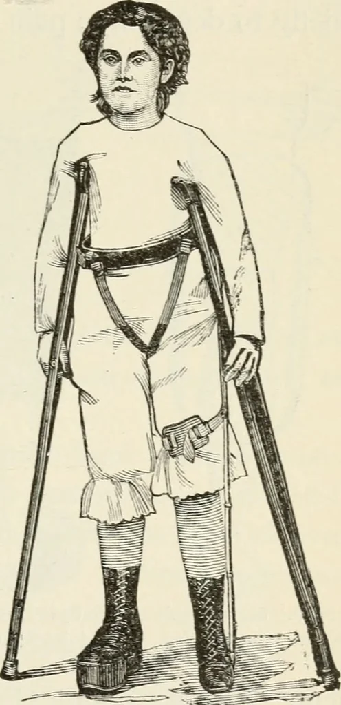 An illustration from A manual of modern surgery, general and operative : With 188 illus. in the text and 13 full-page plates in colors and tints, aggregating 276 separate figures., 1894, leaf 435