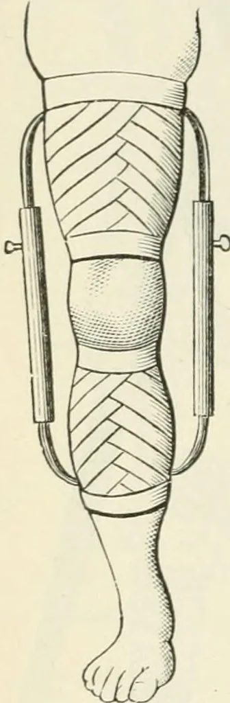 An illustration from A manual of modern surgery, general and operative : With 188 illus. in the text and 13 full-page plates in colors and tints, aggregating 276 separate figures., 1894, leaf 436