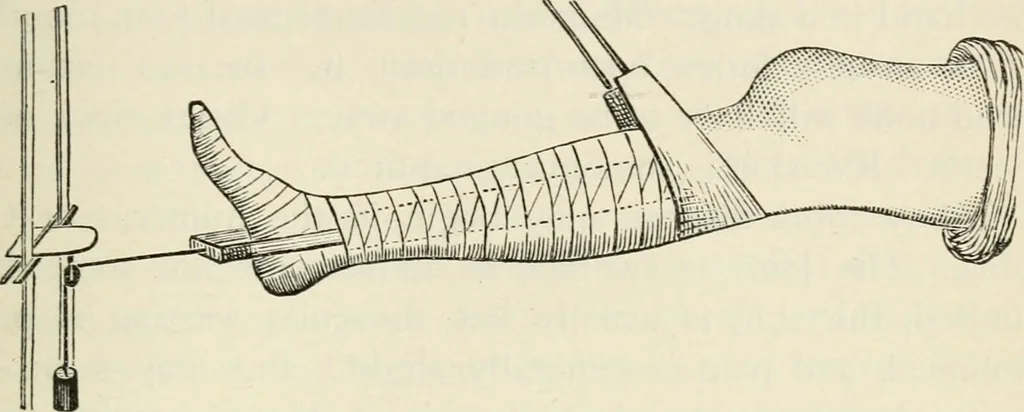 An illustration from A manual of modern surgery, general and operative : With 188 illus. in the text and 13 full-page plates in colors and tints, aggregating 276 separate figures., 1894, leaf 437