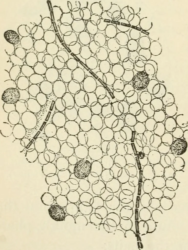 An illustration from A manual of modern surgery, general and operative : With 188 illus. in the text and 13 full-page plates in colors and tints, aggregating 276 separate figures., 1894, leaf 44