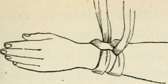 An illustration from A manual of modern surgery, general and operative : With 188 illus. in the text and 13 full-page plates in colors and tints, aggregating 276 separate figures., 1894, leaf 475
