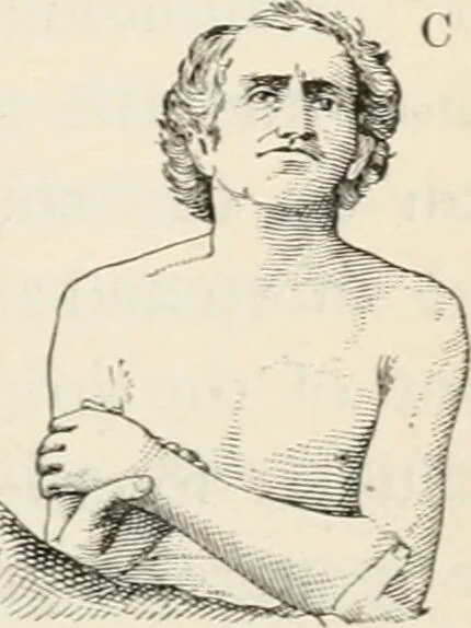 An illustration from A manual of modern surgery, general and operative : With 188 illus. in the text and 13 full-page plates in colors and tints, aggregating 276 separate figures., 1894, leaf 475