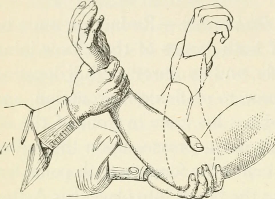 An illustration from A manual of modern surgery, general and operative : With 188 illus. in the text and 13 full-page plates in colors and tints, aggregating 276 separate figures., 1894, leaf 478