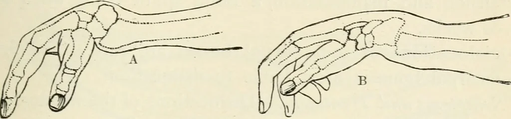 An illustration from A manual of modern surgery, general and operative : With 188 illus. in the text and 13 full-page plates in colors and tints, aggregating 276 separate figures., 1894, leaf 481
