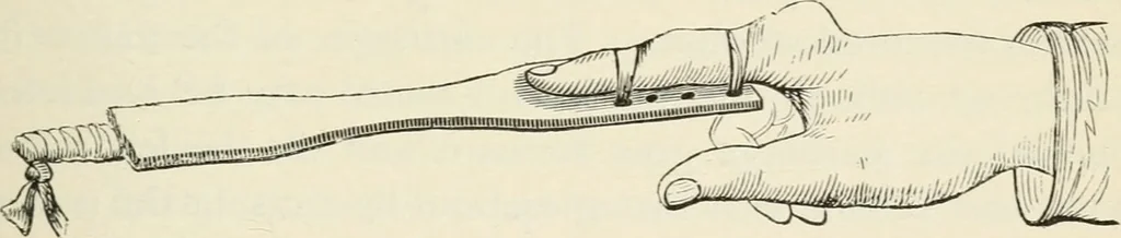 An illustration from A manual of modern surgery, general and operative : With 188 illus. in the text and 13 full-page plates in colors and tints, aggregating 276 separate figures., 1894, leaf 483