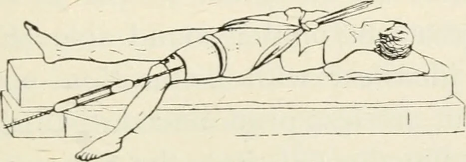 An illustration from A manual of modern surgery, general and operative : With 188 illus. in the text and 13 full-page plates in colors and tints, aggregating 276 separate figures., 1894, leaf 487