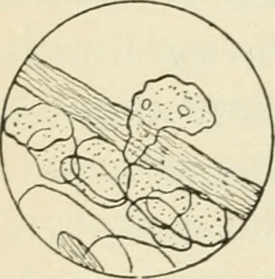 An illustration from A manual of modern surgery, general and operative : With 188 illus. in the text and 13 full-page plates in colors and tints, aggregating 276 separate figures., 1894, leaf 50