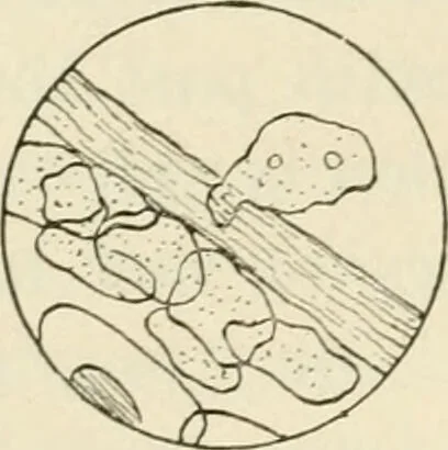 An illustration from A manual of modern surgery, general and operative : With 188 illus. in the text and 13 full-page plates in colors and tints, aggregating 276 separate figures., 1894, leaf 50