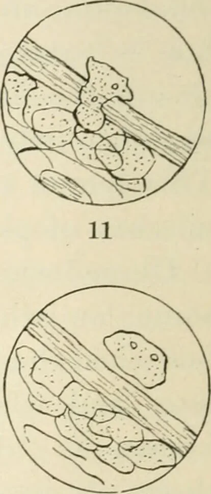 An illustration from A manual of modern surgery, general and operative : With 188 illus. in the text and 13 full-page plates in colors and tints, aggregating 276 separate figures., 1894, leaf 50