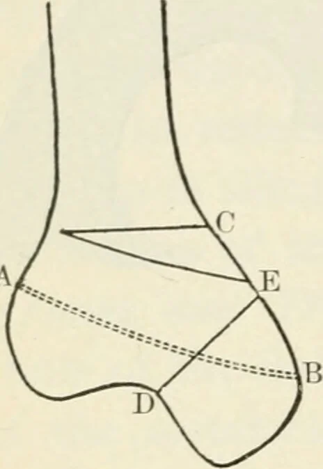 An illustration from A manual of modern surgery, general and operative : With 188 illus. in the text and 13 full-page plates in colors and tints, aggregating 276 separate figures., 1894, leaf 500