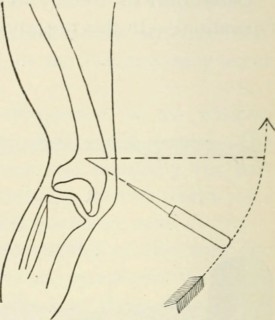 An illustration from A manual of modern surgery, general and operative : With 188 illus. in the text and 13 full-page plates in colors and tints, aggregating 276 separate figures., 1894, leaf 500