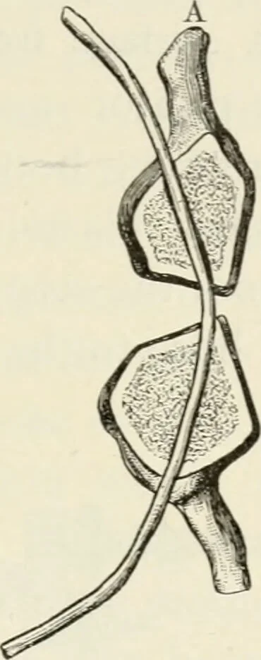An illustration from A manual of modern surgery, general and operative : With 188 illus. in the text and 13 full-page plates in colors and tints, aggregating 276 separate figures., 1894, leaf 507