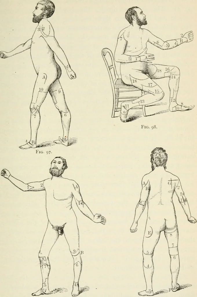 An illustration from A manual of modern surgery, general and operative : With 188 illus. in the text and 13 full-page plates in colors and tints, aggregating 276 separate figures., 1894, leaf 513