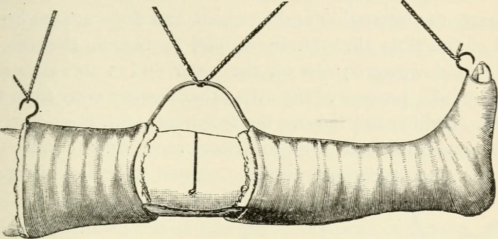 An illustration from A manual of modern surgery, general and operative : With 188 illus. in the text and 13 full-page plates in colors and tints, aggregating 276 separate figures., 1894, leaf 523