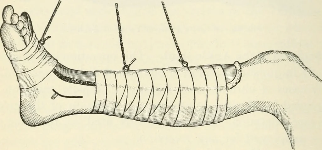 An illustration from A manual of modern surgery, general and operative : With 188 illus. in the text and 13 full-page plates in colors and tints, aggregating 276 separate figures., 1894, leaf 524