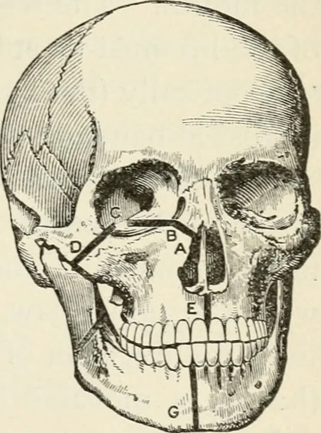 An illustration from A manual of modern surgery, general and operative : With 188 illus. in the text and 13 full-page plates in colors and tints, aggregating 276 separate figures., 1894, leaf 529