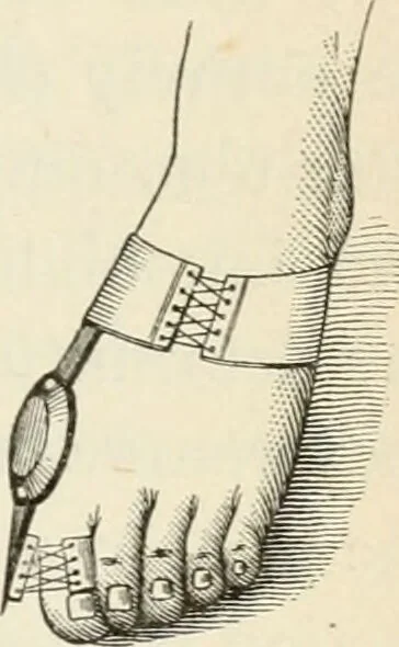 An illustration from A manual of modern surgery, general and operative : With 188 illus. in the text and 13 full-page plates in colors and tints, aggregating 276 separate figures., 1894, leaf 543